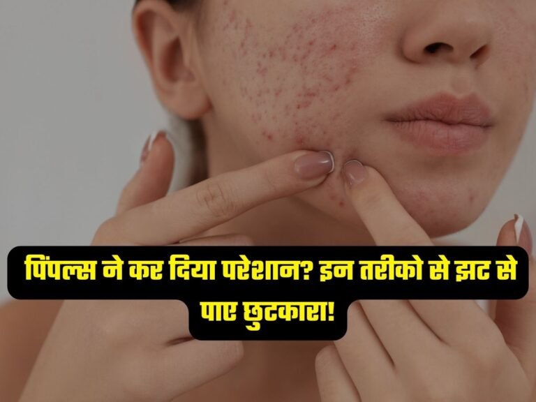 Pimples Remedies